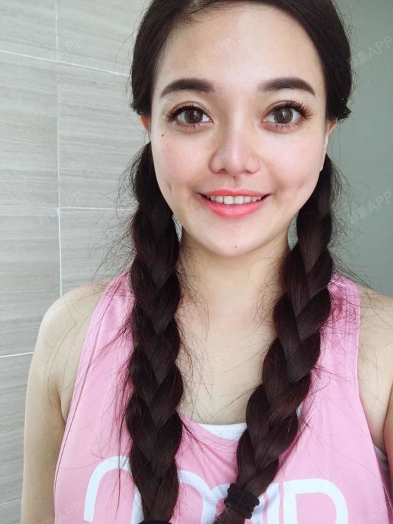 酒窝成形术好不好_效果图_氧气z4ghh酒窝成形术术后第14天_新氧美容