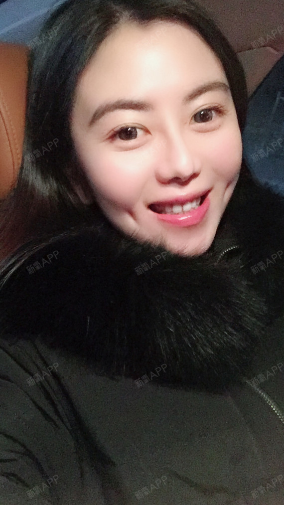 氧气ziekz酒窝成形术术后第14天美丽日记_新氧整形