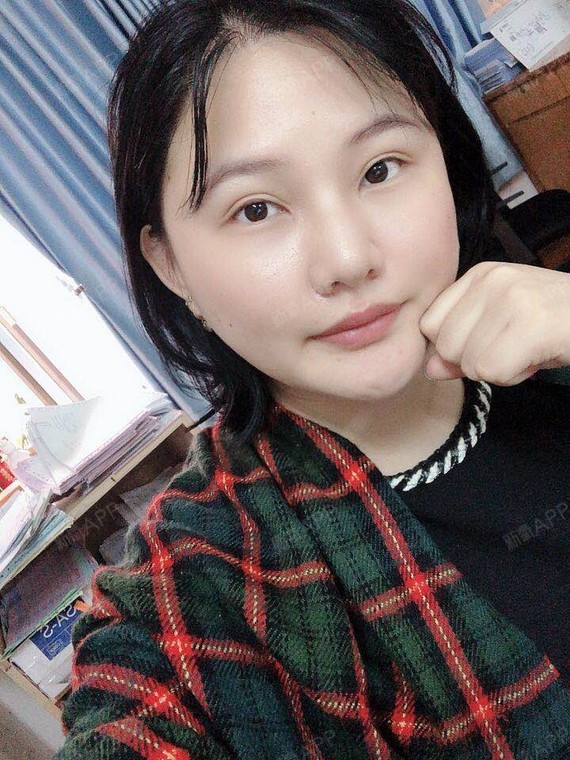 沸沸扬扬za下眼下至术第45天美丽日记-新氧美