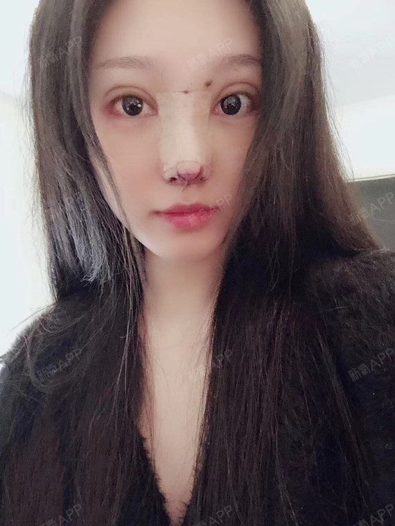 术后第10天手术项目:埋线双眼皮提肌修复,后眼角下_圈子-新氧美容整形