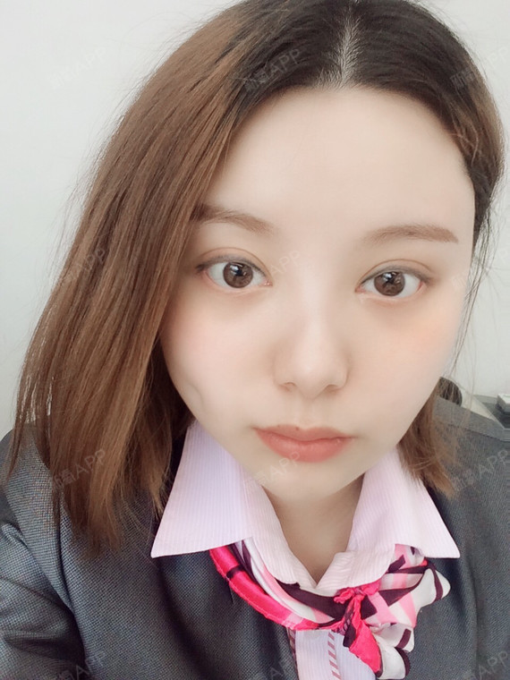 百达丽埋线酒窝术后一周,时间做的还是很快的嘛,我上_圈子-新氧美容