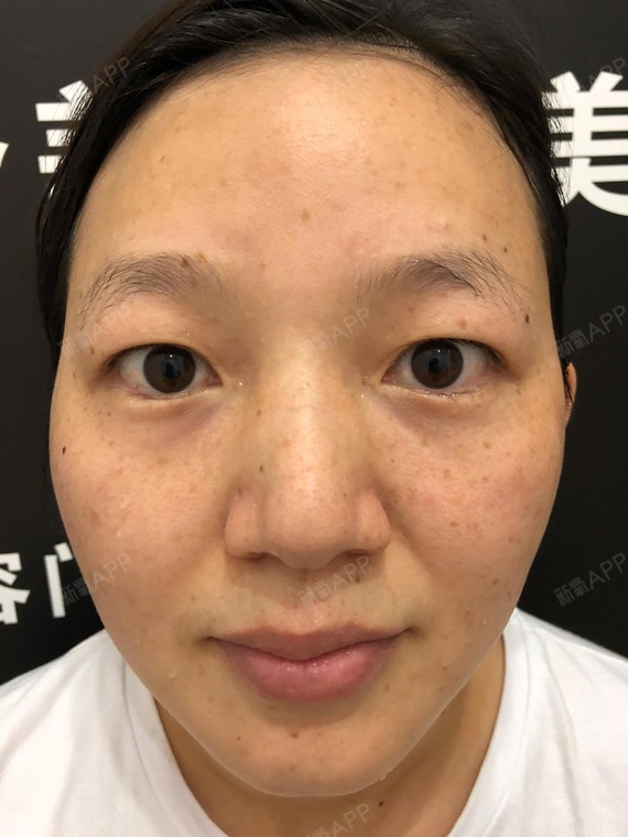 从小就长斑,别人脸上都是干干净净的,我脸上就有些小_圈子-新氧美容