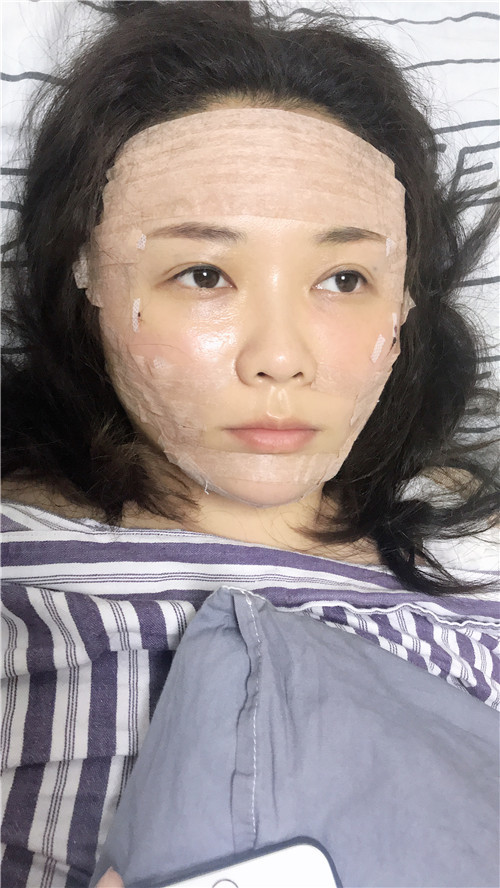 自体脂肪全脸填充第1天