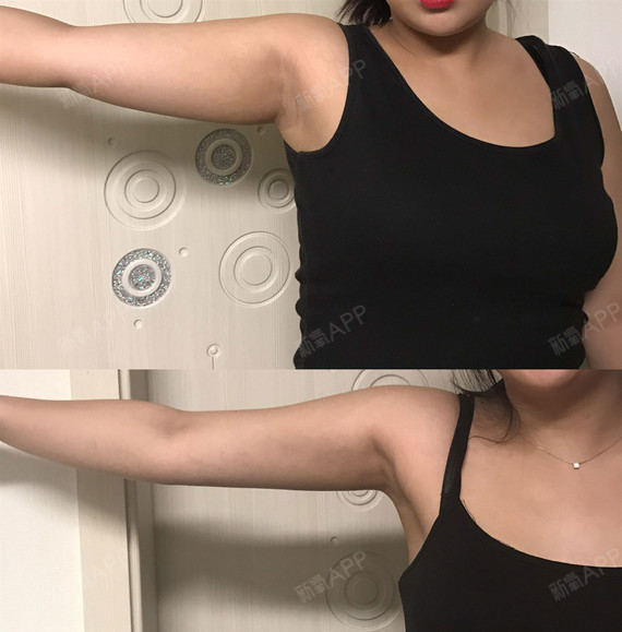 手臂基本上就这样了 前几天去复诊院长说硬块也差不多了