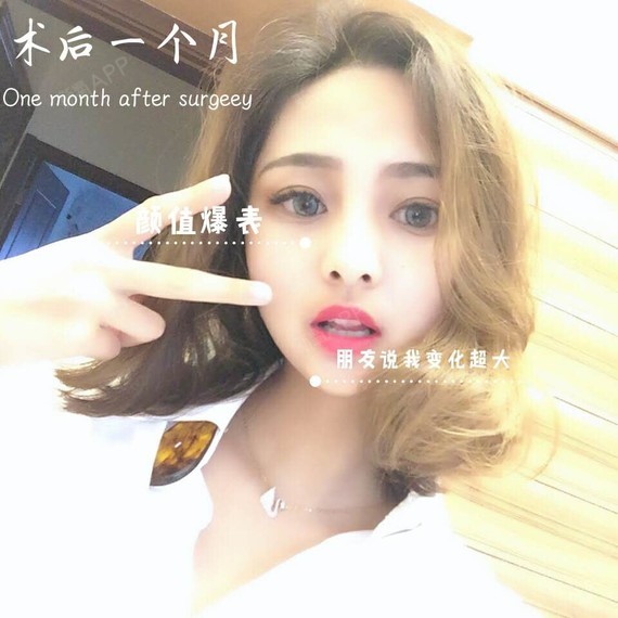 双眼皮宛若天生的秘密--眼综合了解一下今天为