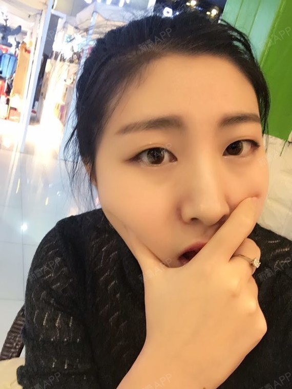 沉阳友谊美容医院刘金超院长双眼皮案例分享 萱萱是 圈子 新氧美容整形