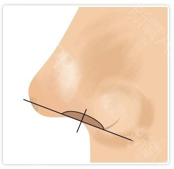 1,鼻翼缘退缩/缺失