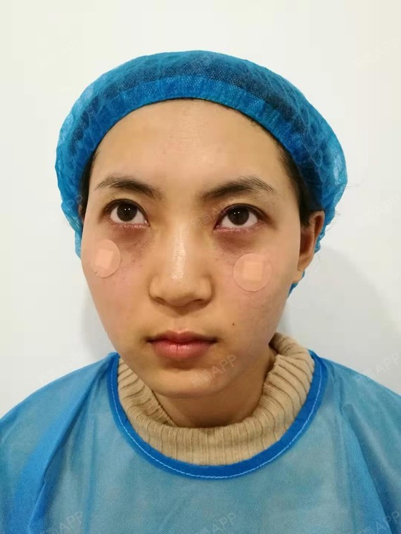 常德内切去眼袋好不好_效果图_氧气0brav内切去眼袋术后第0天_新氧