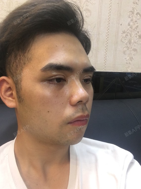 埋线双眼皮好不好_效果图_氧气zdpsh埋线双眼皮术后第15天_新氧美容