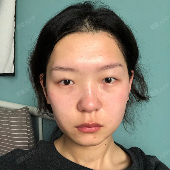 其实我的眼睛没有什么多余的赘肉和脂肪做埋线双眼皮也可以的可是为了