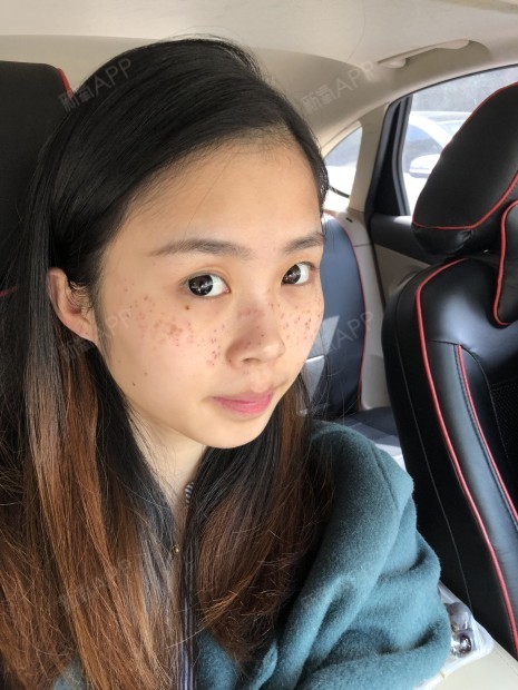 大学毕业做过一次激光祛斑,效果不是特别好,感觉祛的不是很彻底,这