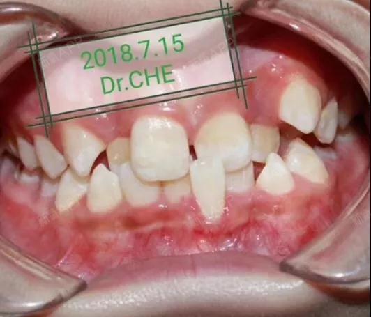 不齐小孩的牙齿图片儿童牙参差不齐图片乱长的牙齿参差不齐儿童牙齿小