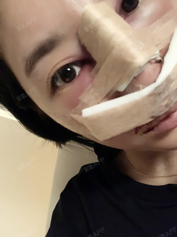 【鼻部多项 鼻骨内推第3天】