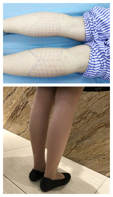 瘦腿针开始起效果了