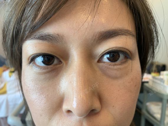 采尼姑的萌萌内切去眼袋第3天美丽日记