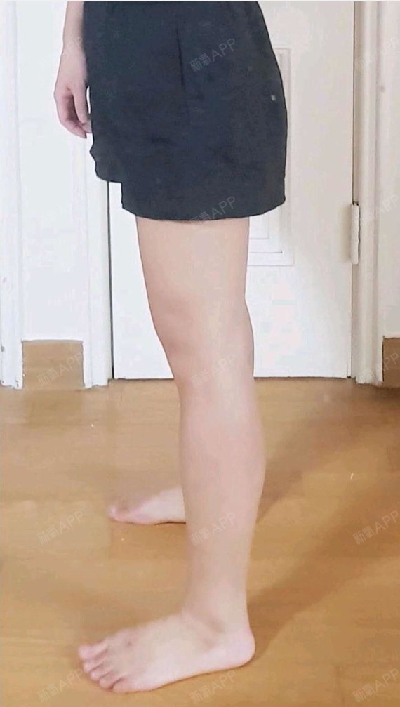 19天了,凸显出来的小腿肌肉明显改善了很多,小腿线_圈子-新氧美容整形