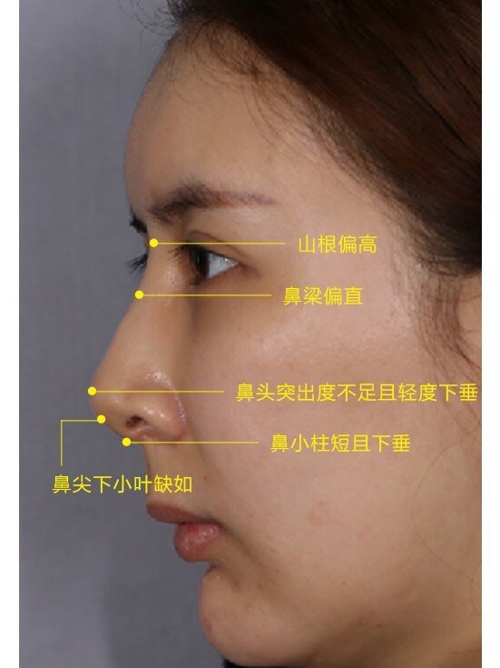 侧面:鼻梁较直,鼻尖下小叶缺如,小柱小叶转角偏大,鼻小柱悬垂,鼻翼缘