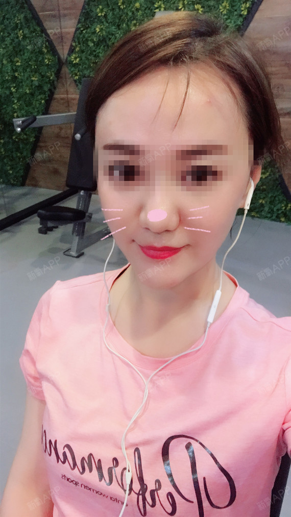 深圳瓷贴面好不好_效果图_氧气z7gjj瓷贴面术后第92天_新氧美容整形