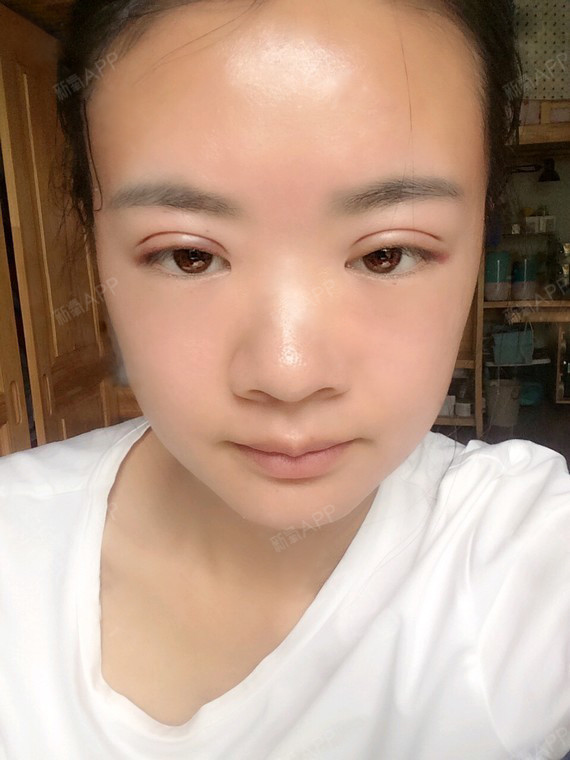 佛山埋线双眼皮好不好_效果图_美眉迷埋线双眼皮术后第3天_新氧美容
