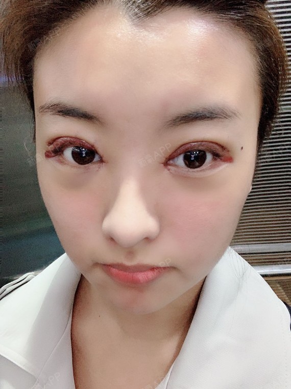 给大家介绍的这位真人案例眼部比较特殊,在我们的_圈子-新氧美容整形