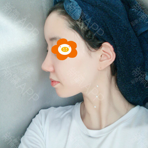 武汉手术缩鼻翼好不好_效果图_氧气0bgnj手术缩鼻翼术后第17天_新氧