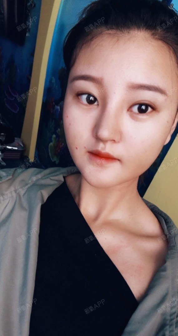 【鼻综合术后第10天】庆祝我的鼻子十天啦,今天化了_圈子-新氧美容