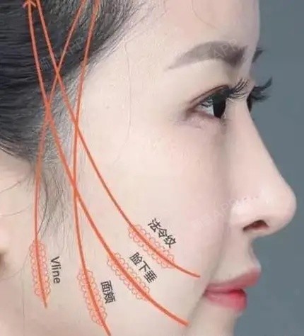 全脸线雕有什么副作用吗凭什么让女人为之疯狂