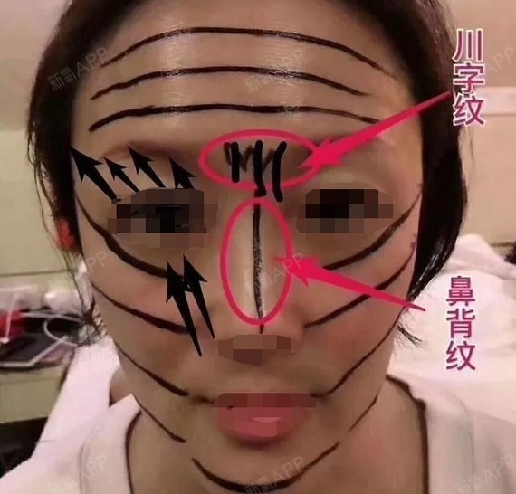 黄金线雕是什么原理?真的有那么神奇吗?来看看!