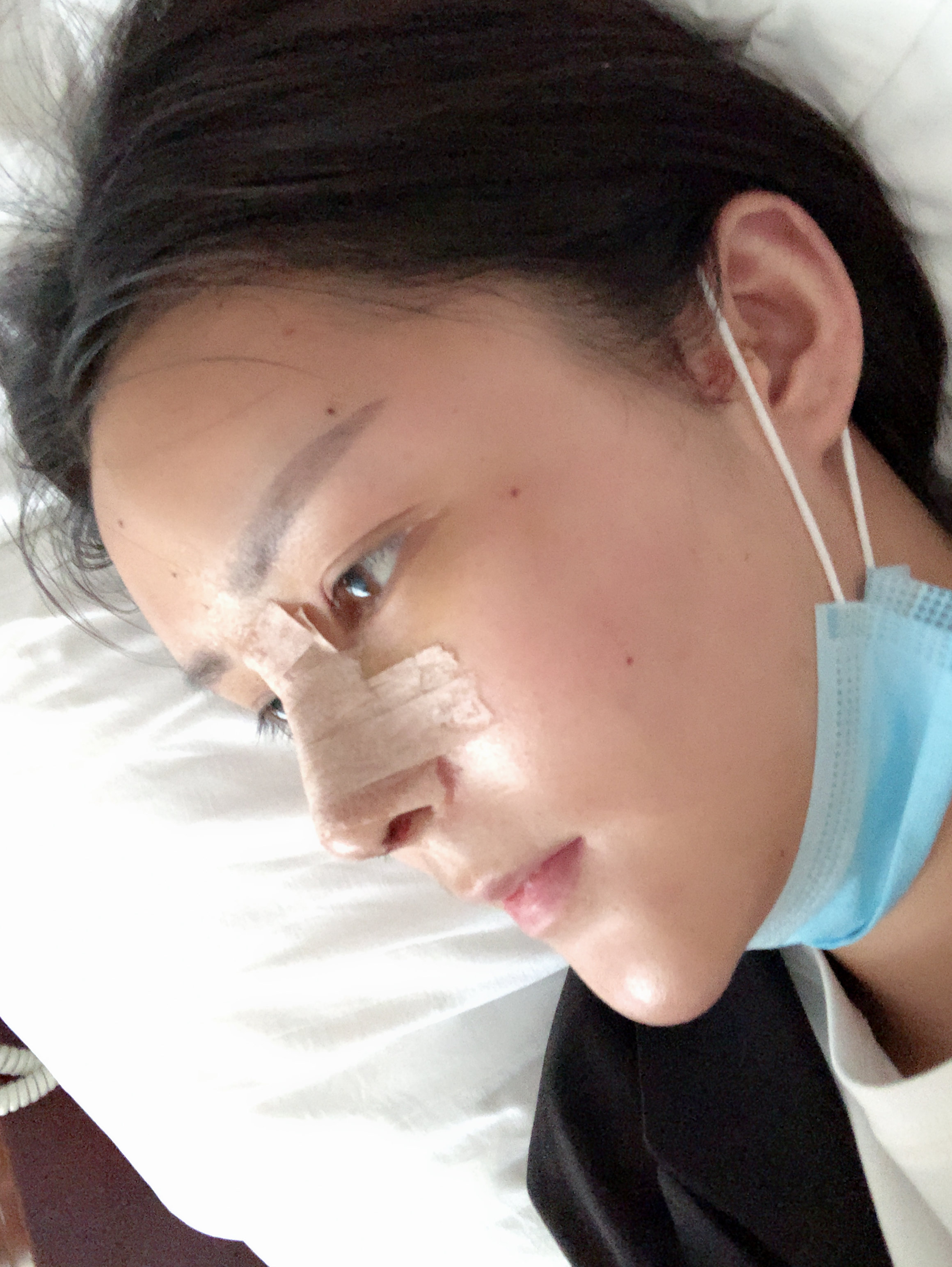 成都素美医疗美容膨体隆鼻怎么样_恢复过程_效果如何_叶娘娘整形日记