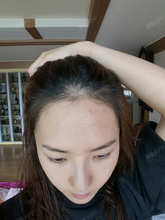 【毛杰琳植发医院】教你正确处理植发后的毛囊