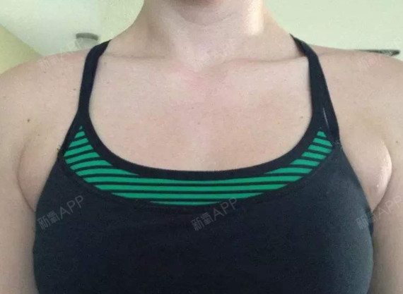 副乳及出现副乳的原因