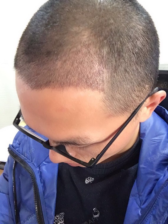 zzann种植发际线第15天美丽日记