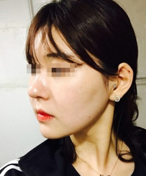 孟小星星溶脂针瘦脸第14天美丽日记