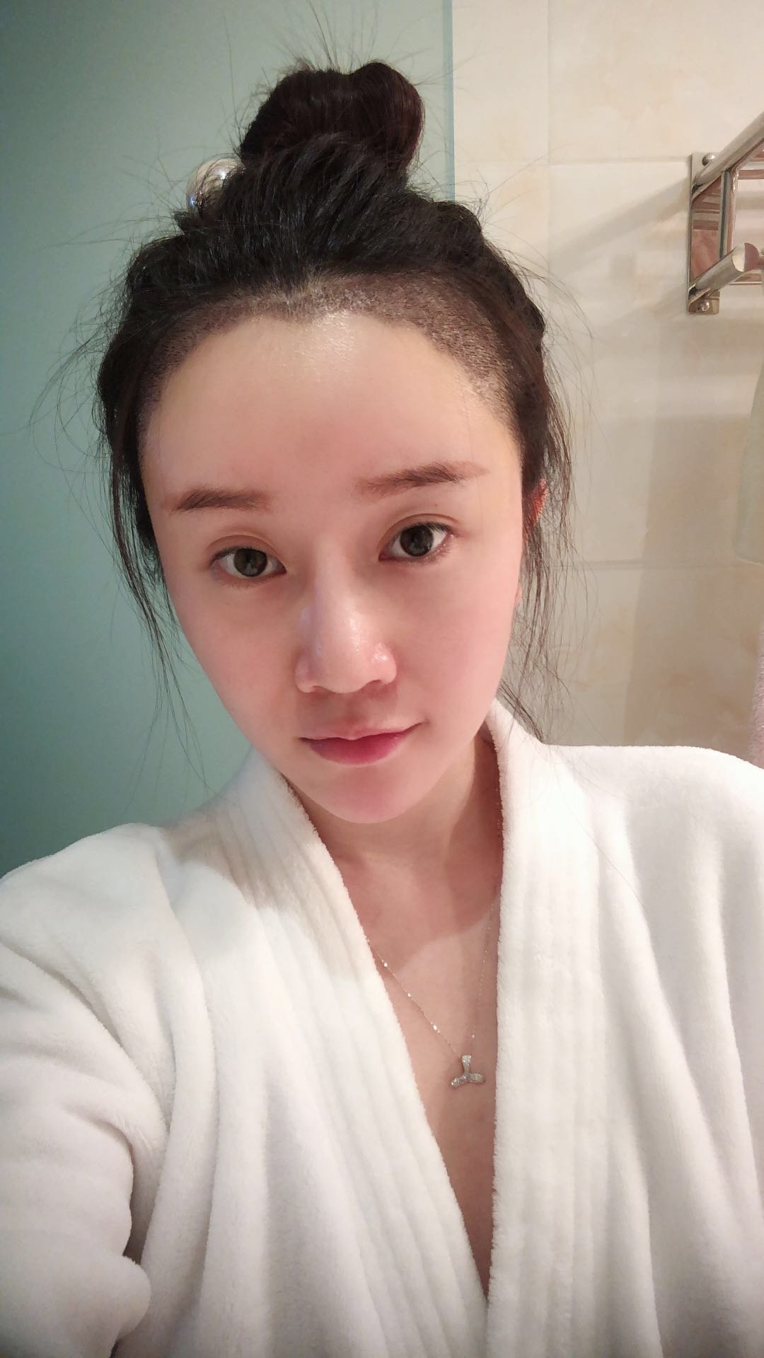 发际线调整日记分享~我额头比较大,每次扎丸子头的时_圈子-新氧美容