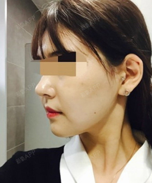 孟小星星溶脂针瘦脸第14天美丽日记