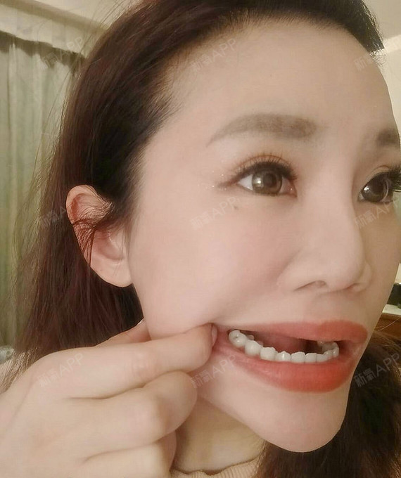 根管治疗,烤瓷牙,怎么选?忽悠?