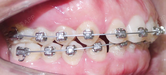 牙齿矫正不就是戴几根铁丝,为什么不能自己箍?