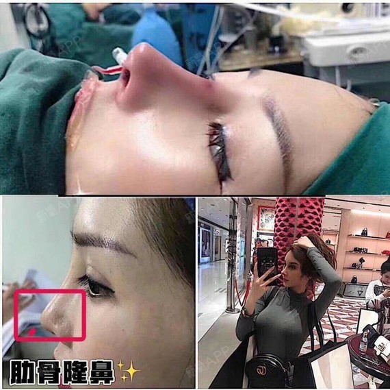 假体隆鼻,该选硅胶好还是膨体好?