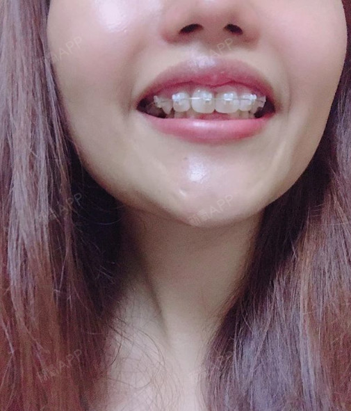 最近的咬合长这样渐渐可以看到下排牙齿神奇吧打骨钉好_圈子-新氧美容