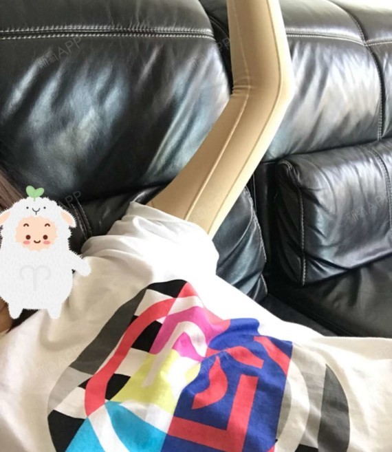 感: 疤痕度: 吸脂手臂,真的是麒麟来着,现在很好了,手臂细了很多了!