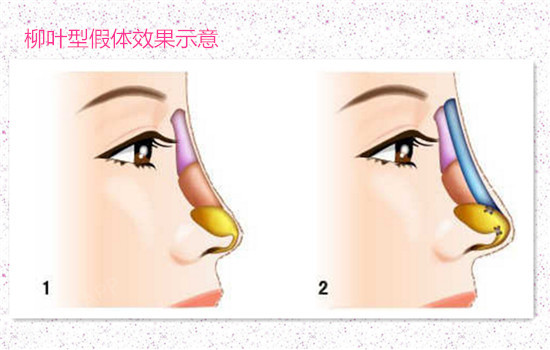 L型假体和柳叶形假体的区别:L型硅胶假体:主要