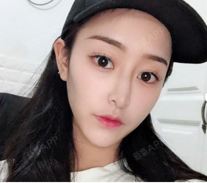 植发后毛囊炎怎么形成的[:32]。能用怎样的方式