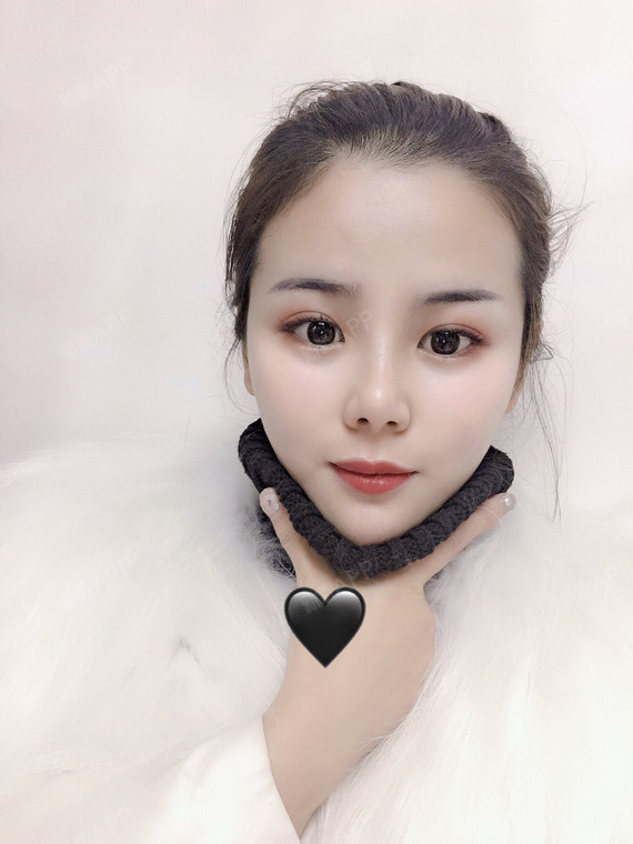 眼睑下至的效果真的超级棒啊,眼睛大了一圈,而且眼型_圈子-新氧美容