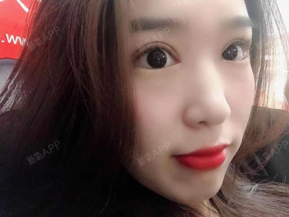 【青岛伊美尔5s重睑术后21天】术后21天啦,到现_圈子-新氧美容整形