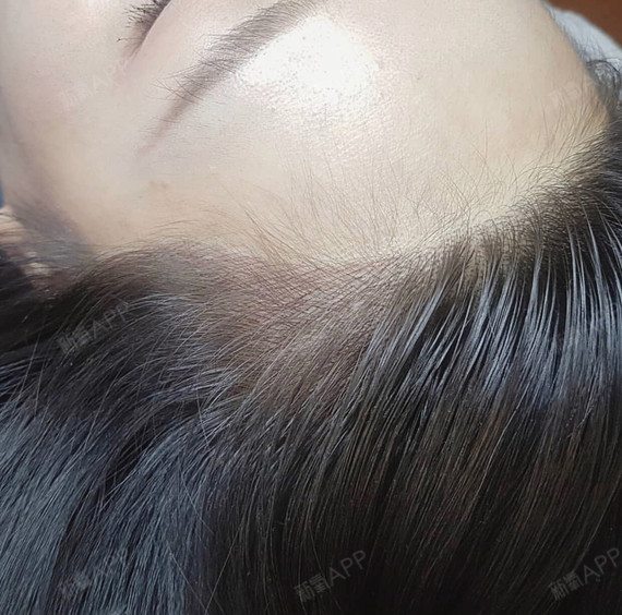 【毛杰琳植发中心为您解疑答惑,解锁变美新姿