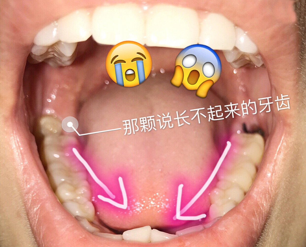 拔智齿能瘦脸吗图片