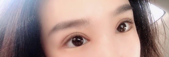 【青岛伊美尔5s重睑术后21天】术后21天啦,到现_圈子-新氧美容整形