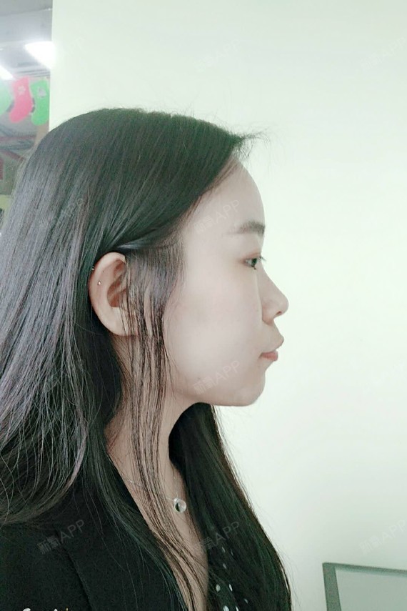 隐形托槽矫正好不好_效果图_氧气zzazn隐形托槽矫正术后第55天_新氧