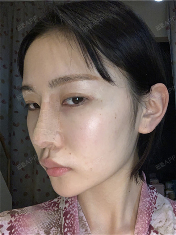 膨体隆鼻好不好_效果图_氧气0vacj膨体隆鼻术后第2天_新氧美容整形