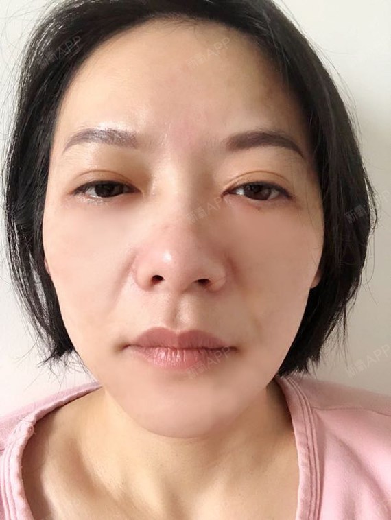 广州内切去眼袋好不好_效果图_氧气0qsz7内切去眼袋术后第3天_新氧